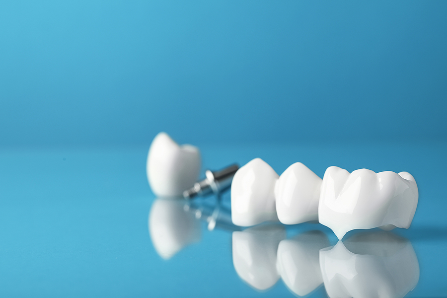 Restore Your Smile with Dental Crowns and Bridges in Palm Bay, FL