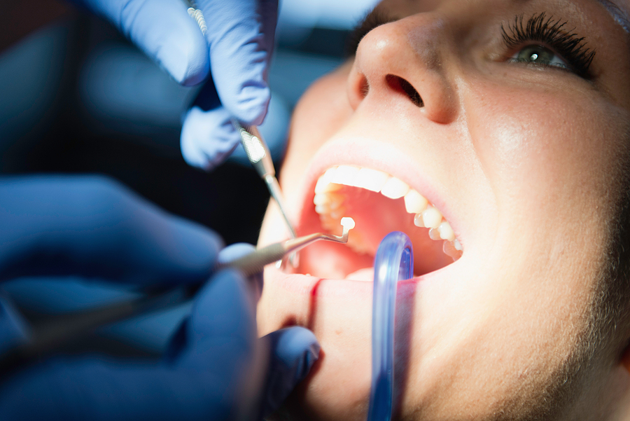 Restore Your Smile with Tooth Fillings in Palm Bay, FL