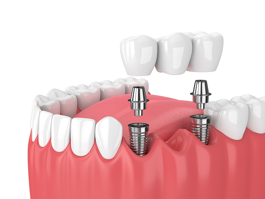 Restore Your Smile with Dental Implant Restorations in Palm Bay, FL