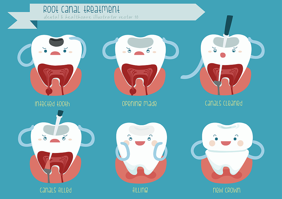 Everything You Need to Know About Root Canals in Palm Bay, FL Everything You Need to Know About Root Canals in Palm Bay, FL